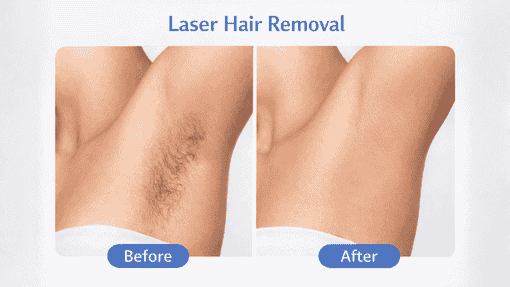 Choose Laser Hair Removal in Anjanapura