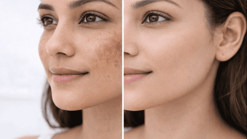 Pigmentation Laser Treatment in Narayan Nagar, Bangalore