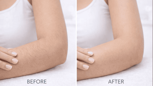 Smooth Skin with Confidence